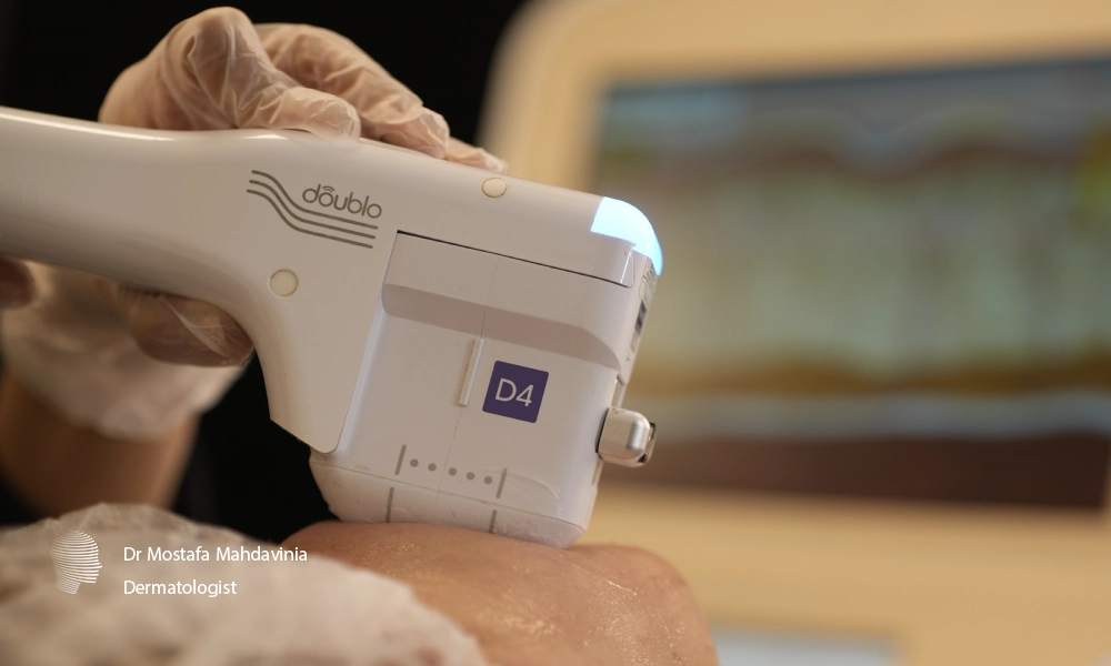 خانمی در حال هایفوتراپی در کلینیک زیبایی دکتر مهدوی نیا