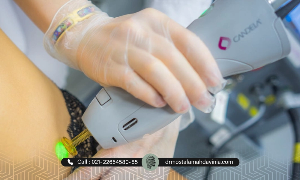 از بین بردن موهای زائد بیکینی با لیزر کندلا | لیزر موهای زائد بیکینی