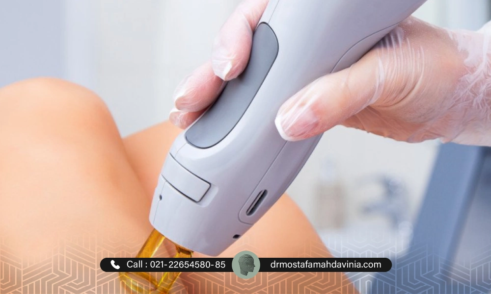 لیزر موهای زائد بیکینی برای ناحیه تناسلی