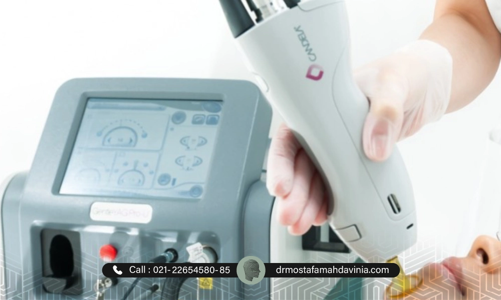 الکساندرایت کندلا بهترین دستگاه لیزر موهای زائد صورت