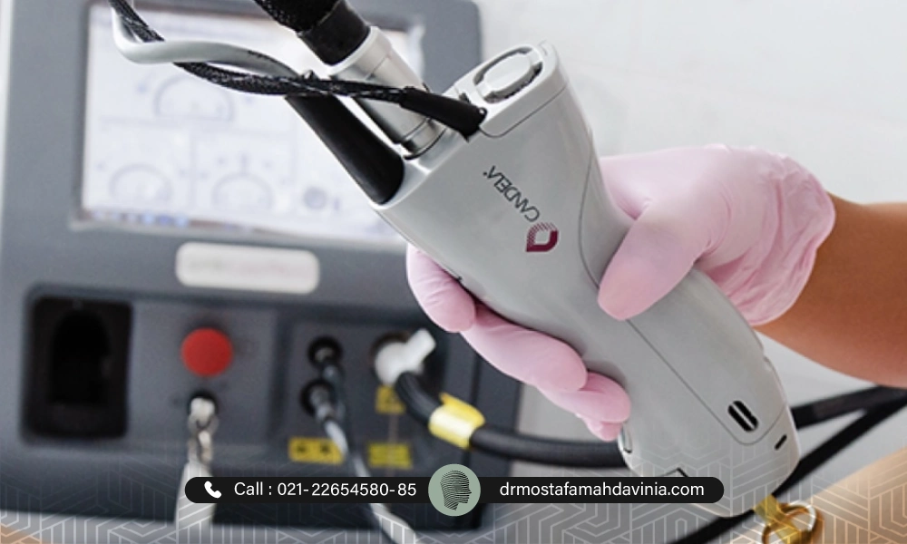 لیزر کندلا برای از بین بردن ناحیه بیکینی