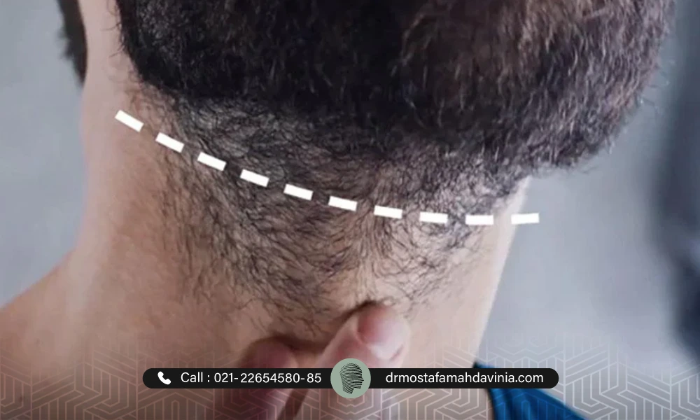 ليزر خط ریش مردان برای زیبایی ریش های آقایان