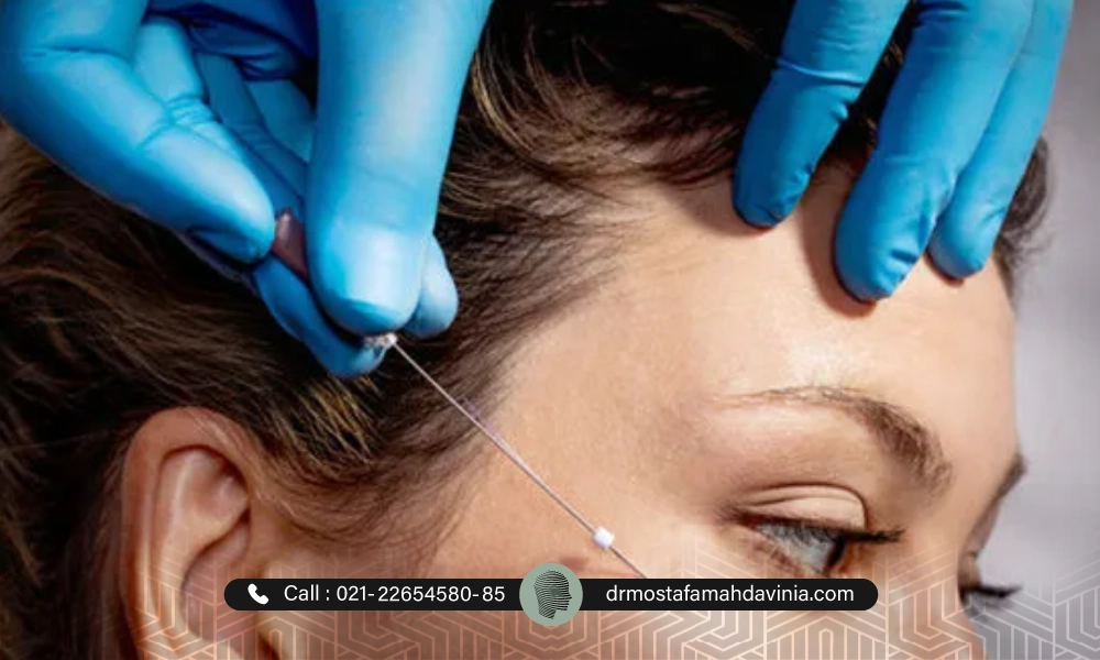 انجام لیفت نخ برای یک خانم توسط پزشک متخصص
