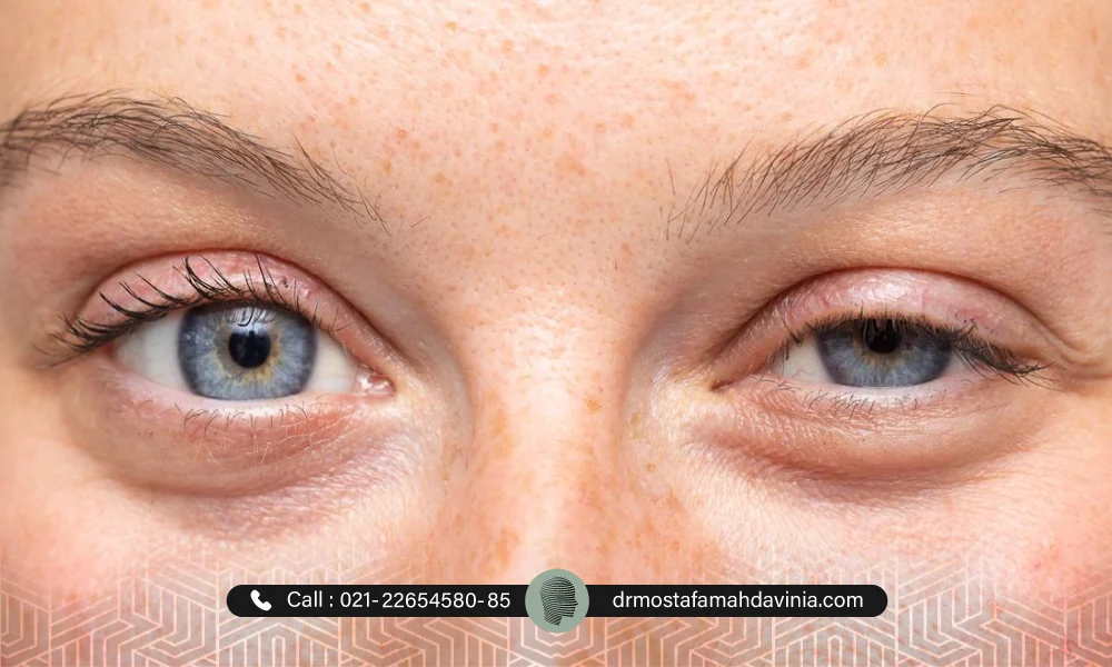 افتادگی پلک چپ یک فرد جوان