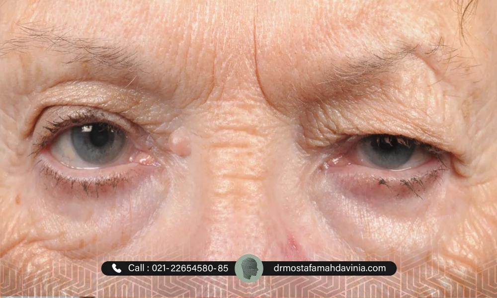 افتادگی پلک به دلیل کهولت سن