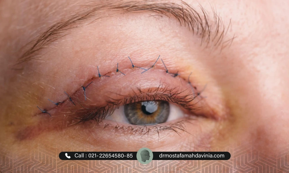 انجام عمل بلفاروپلاستی برای درمان افتادگی پلک