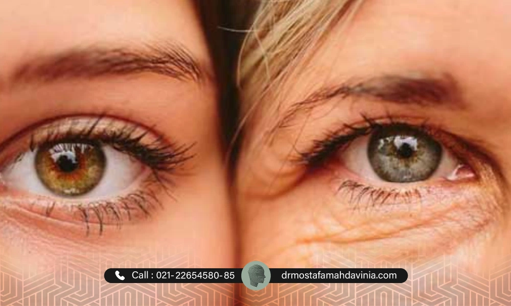 عکس قبل و بعد افتادگی پلک یک خانم