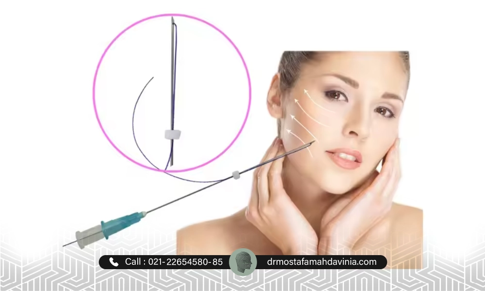 نمایش نخ لیفت برای لیفتینک صورت