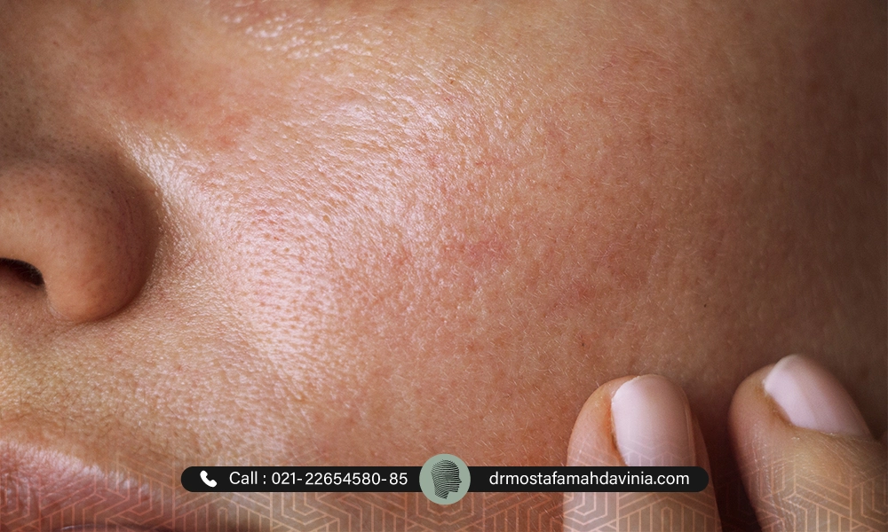 کهیر پوستی صورت یک خانم بعد از لیزر موهای زائد | کهیر پوستی بعد از لیزر موهای زائد