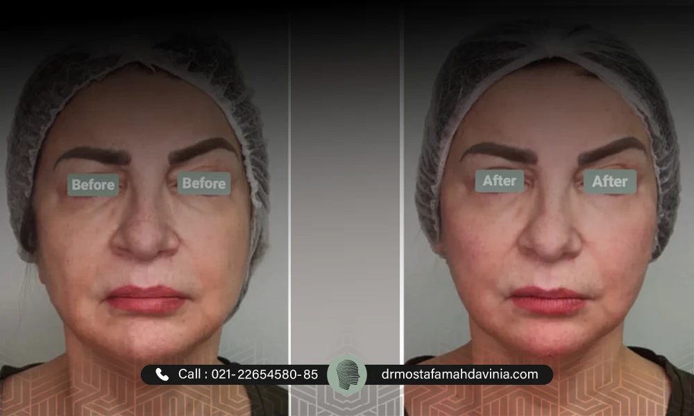 لیفت ابرو با نخ