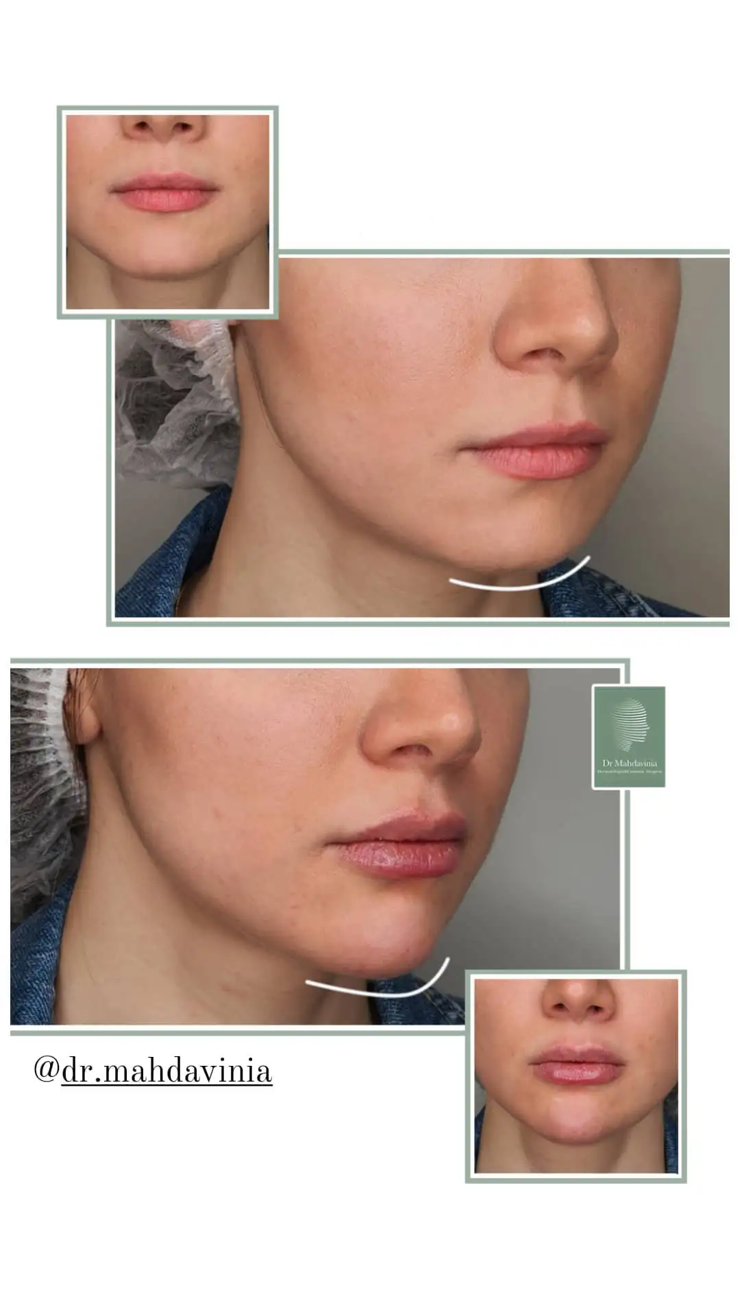 Before-and-after-photos-of-chin-filler-injections