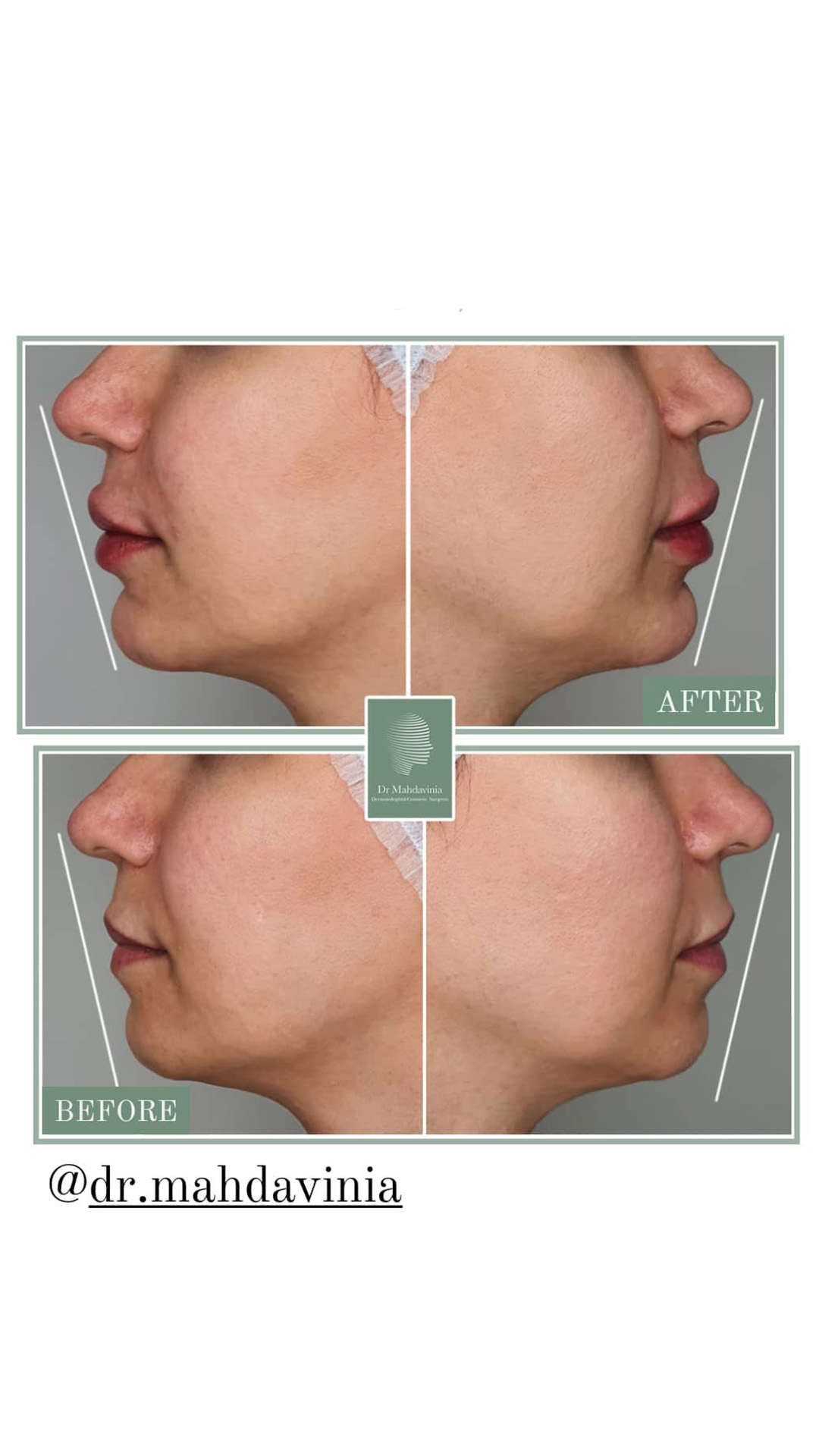 Before-and-after-photos-of-chin-filler-injections-3