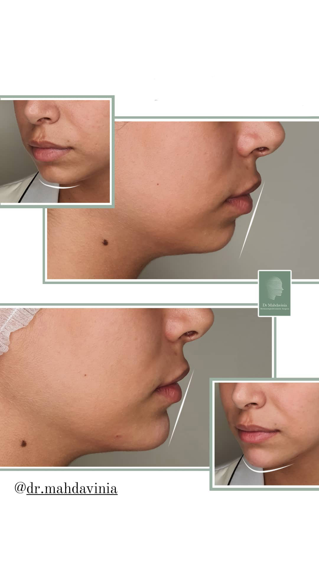 Before-and-after-photos-of-chin-filler-injections-6