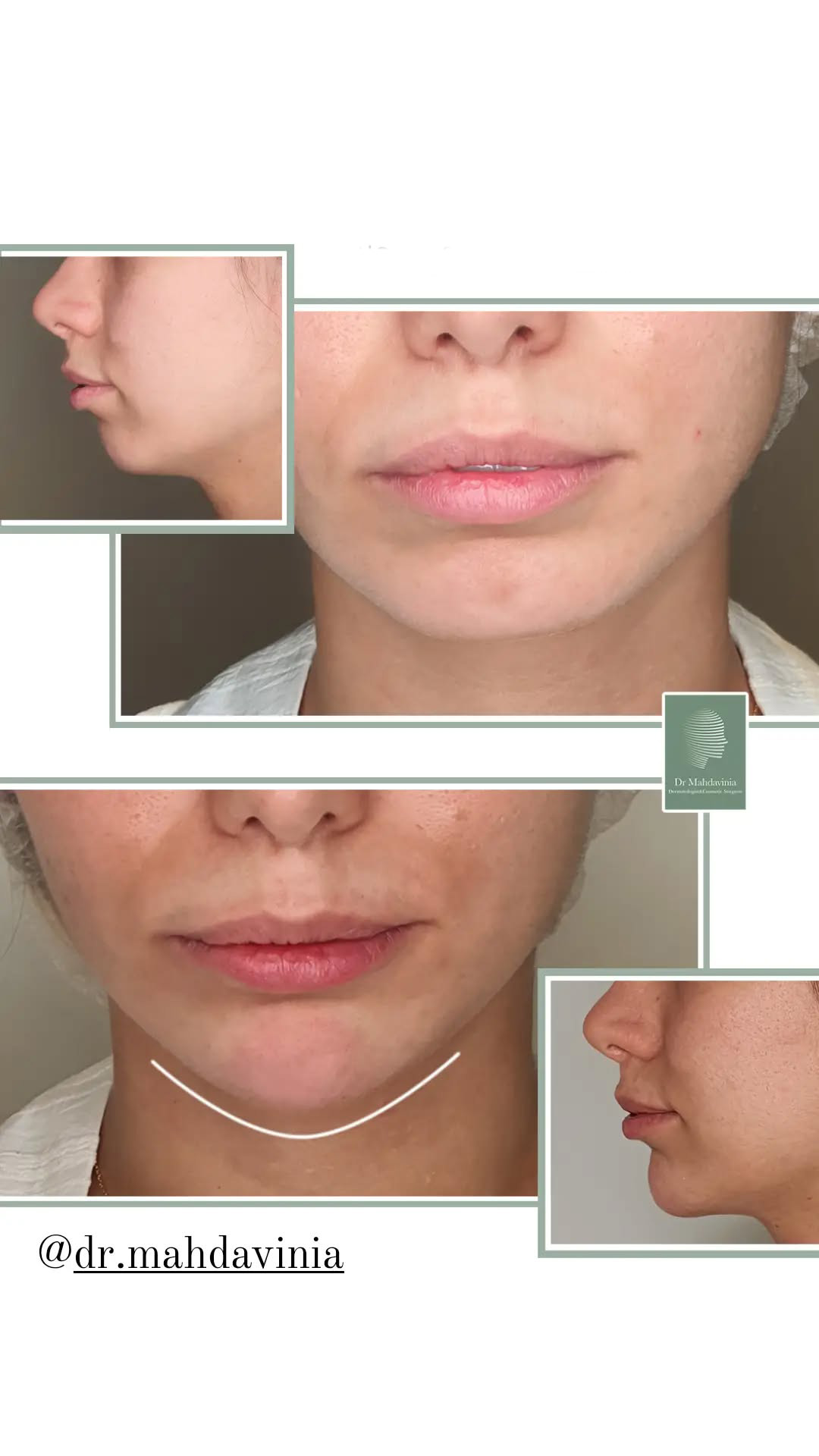 Before-and-after-photos-of-chin-filler-injections-7