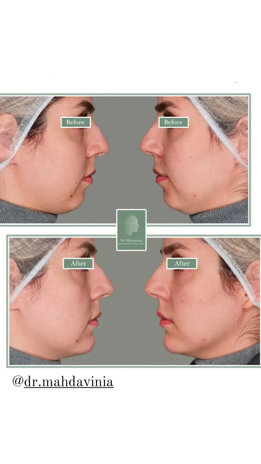 Before-and-after-photos-of-chin-filler-injections-8