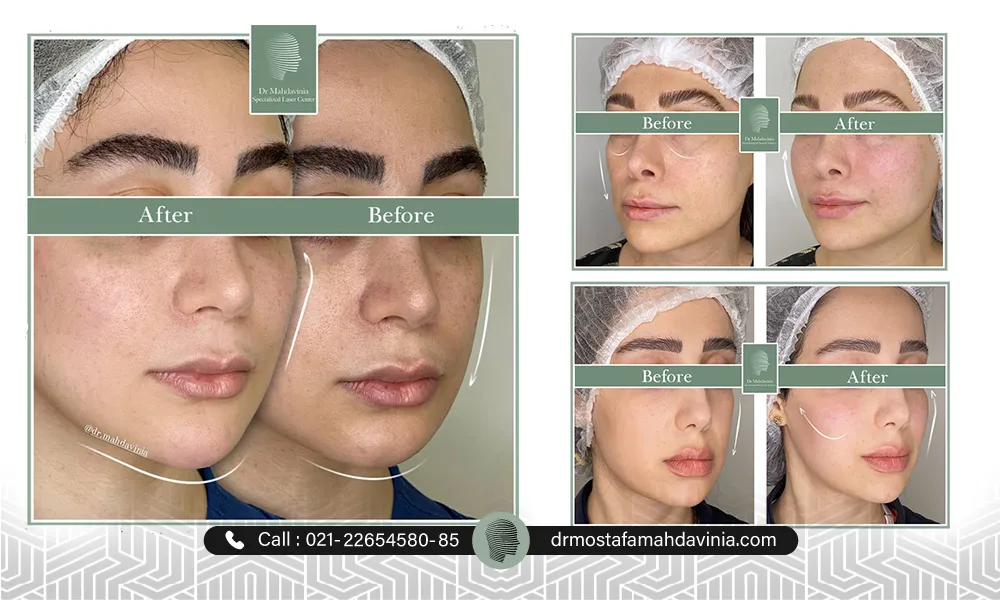 عکس قبل و بعد تزریق فیلر گونه توسط دکتر مهدوی نیا