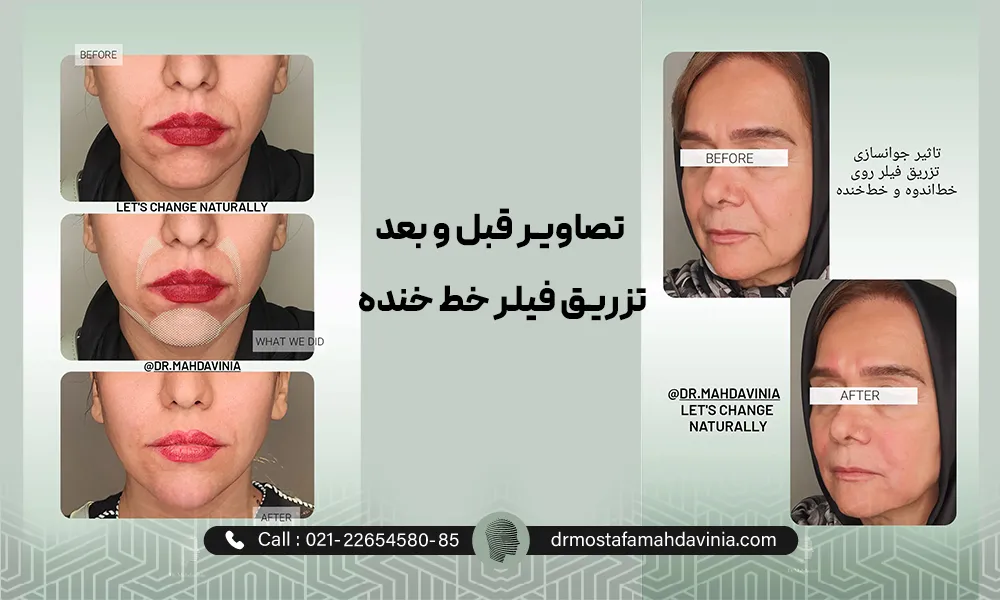عکس فیلر خط خنده 