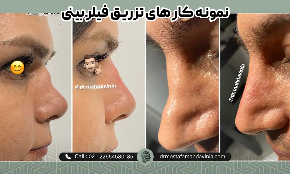 نمونه کار های تزریق فیلر بینی در کلینیک مهدوی نیا