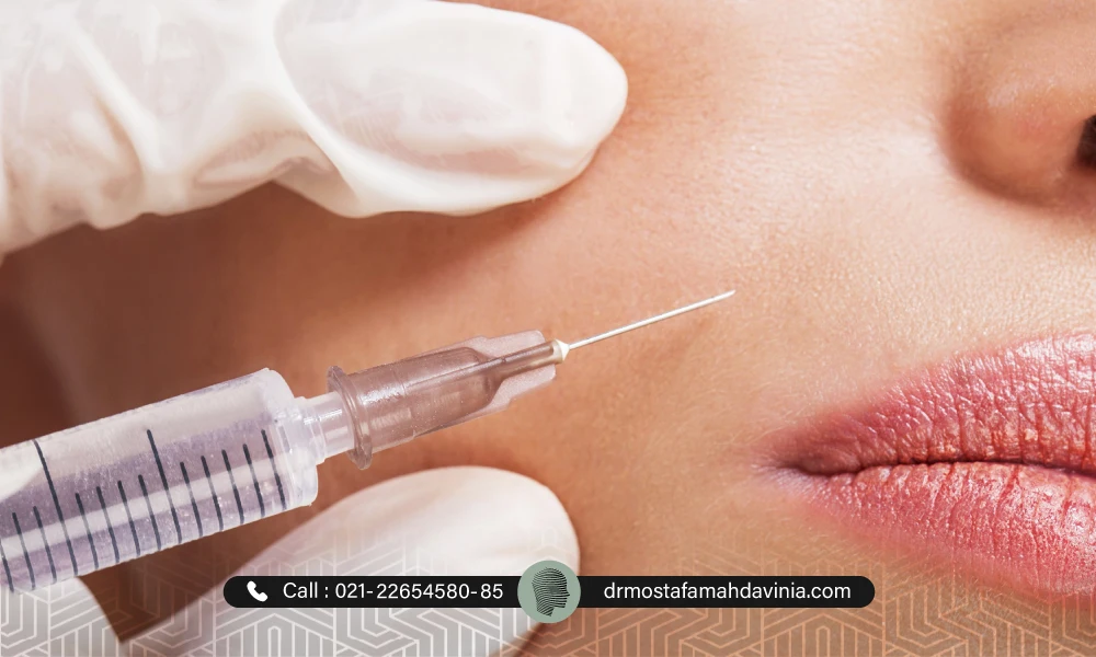 پزشک برای از بین بردن خطوط لبخند در حال تزریق فیلر خط خنده است.