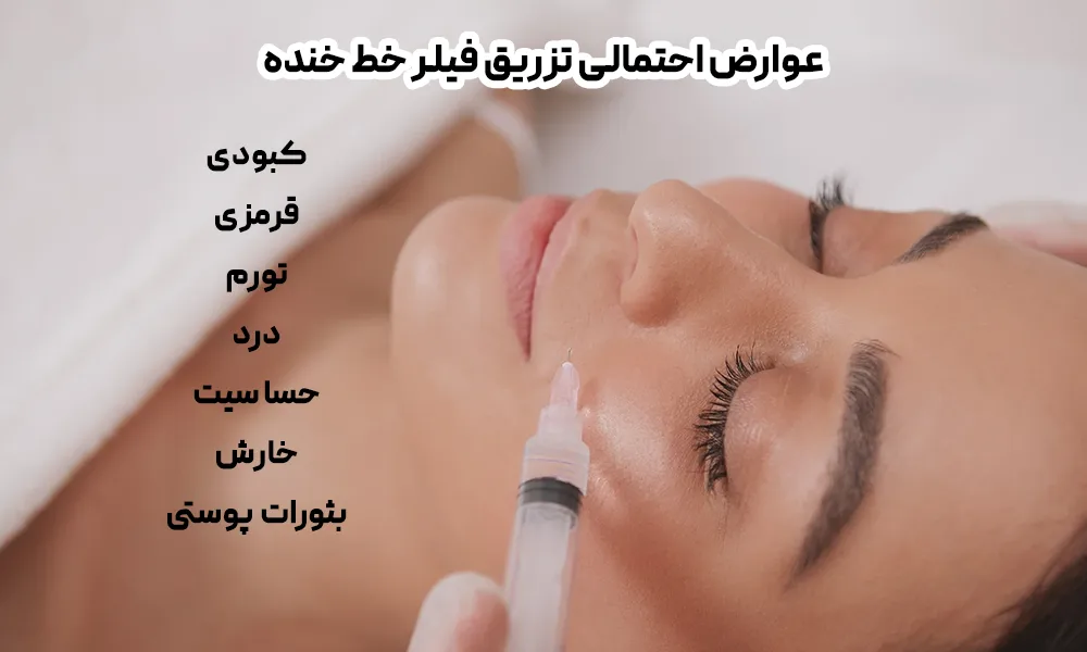 تزریق فیلر خط ماریونت برای یک خانم