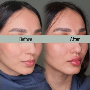 نمونه کار تزریق فیلر گونه