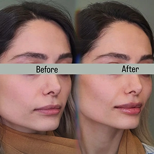 نمونه کار تزریق فیلر گونه