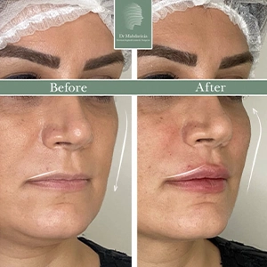 نمونه کار تزریق فیلر گونه