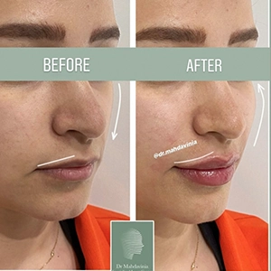 نمونه کار تزریق فیلر گونه