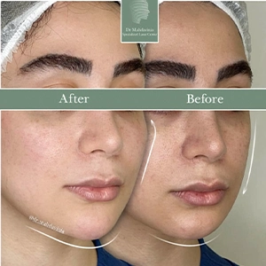 نمونه کار تزریق فیلر گونه