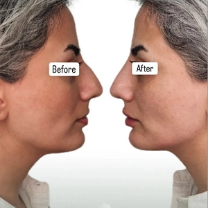 نمونه کار تزریق فیلر بینی