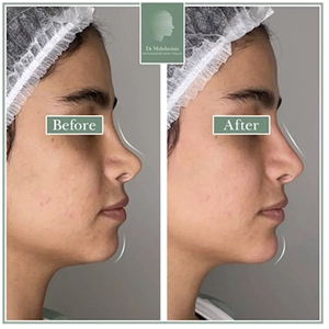 نمونه کار تزریق فیلر بینی