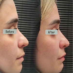 نمونه کار تزریق فیلر بینی