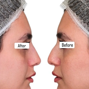 نمونه کار تزریق فیلر بینی