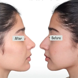 نمونه کار تزریق فیلر بینی