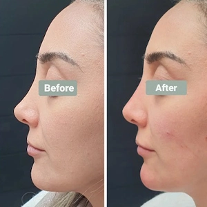 نمونه کار تزریق فیلر بینی