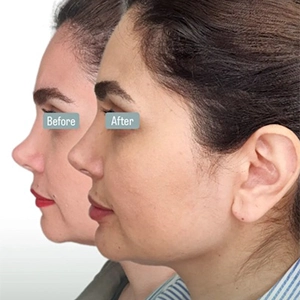 نمونه کار تزریق فیلر بینی