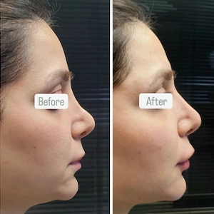 نمونه کار تزریق فیلر بینی