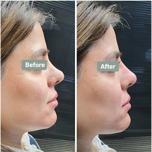 نمونه کار تزریق فیلر بینی