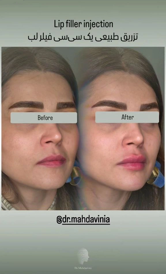 عکس تزریق یک سی سی فیلر لب طبیعی