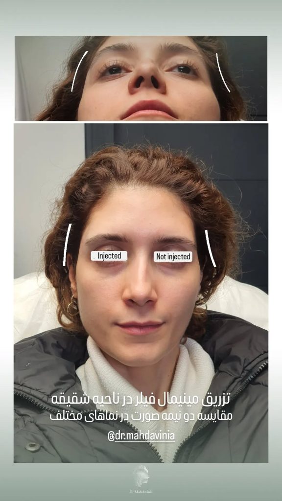 نمونه کار دکتر مهدوی نیا برای تزریق فیلر شقیقه