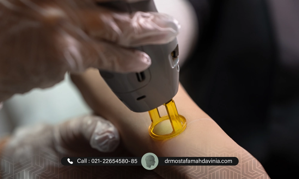 از بین بردن موهای زائد دست با هندپیس کندلا