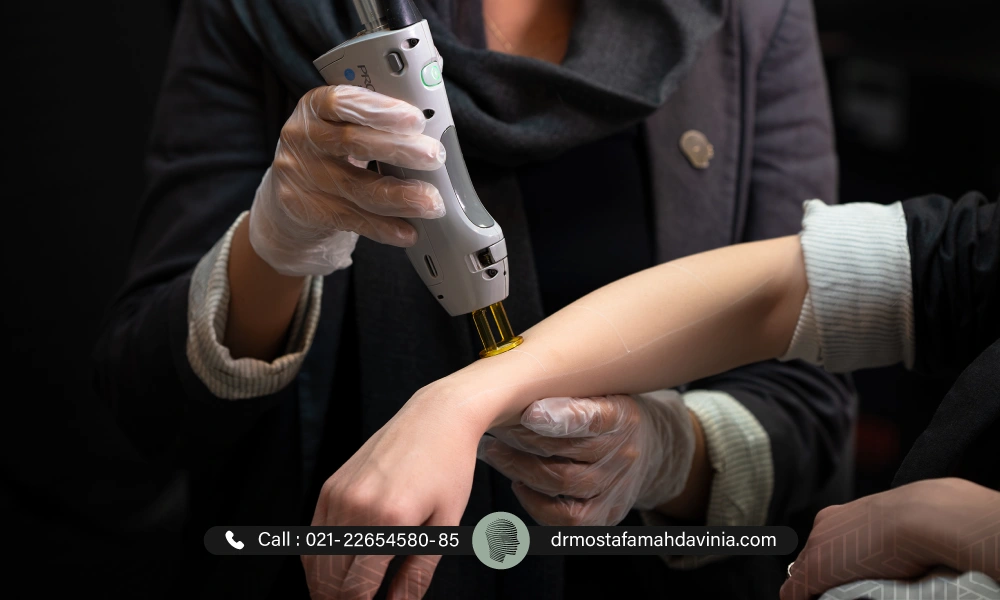 لیزر دست برای موهای زائد