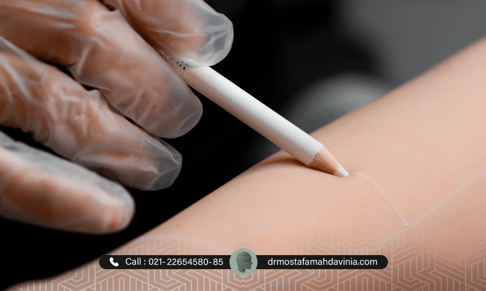 علامتگذاری ناحیه دست برای انجام لیزر مو