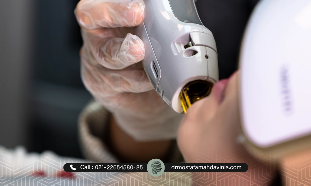 لیزر موهای زائد برای چانه خانم با دستگاه کندلا