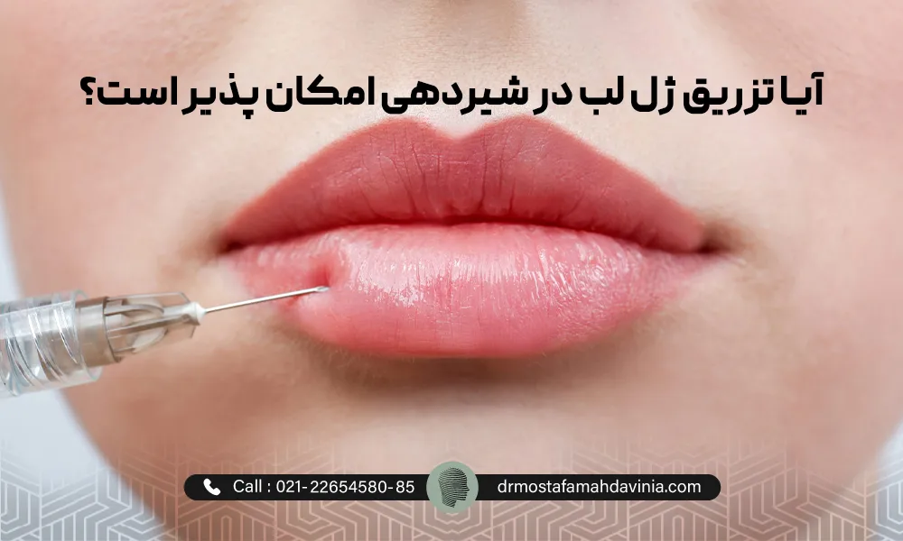 خانمی در حال تزریق ژل لب در شیردهی می باشد