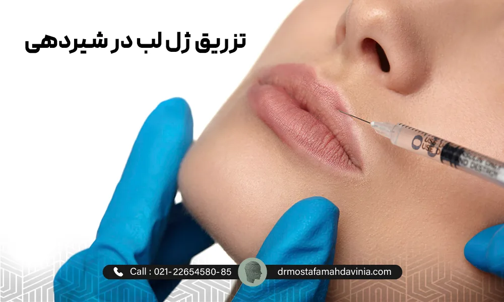 تزریق ژل لب در شیردهی یک حانم