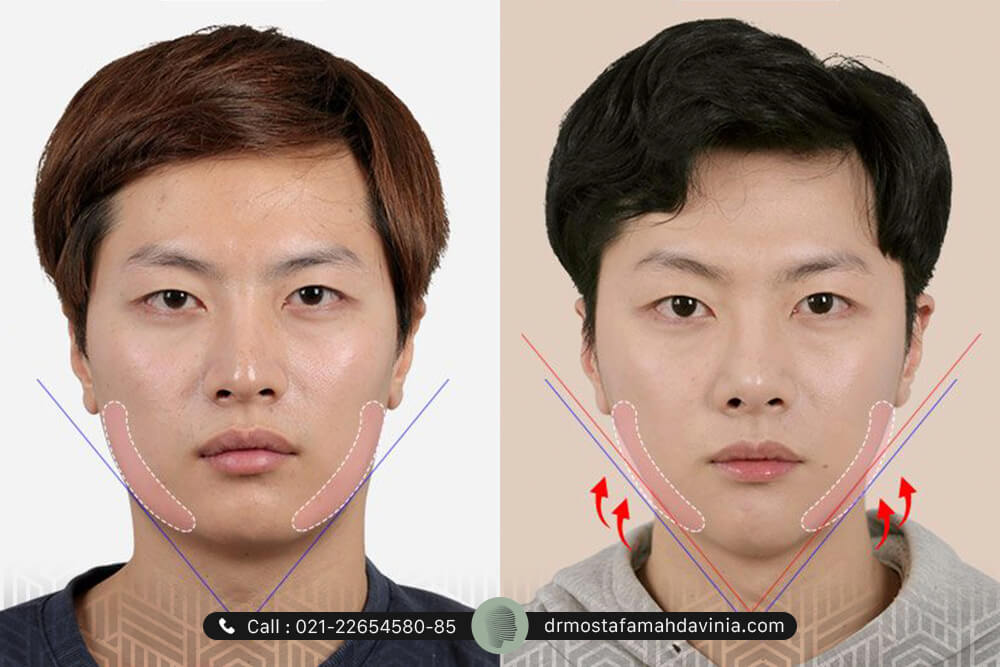 زاویه سازی صورت مردان