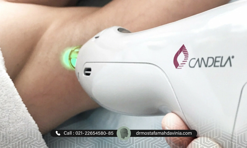 لیزر موهای زائد زیر بغل در کلینیک مهدوی نیا