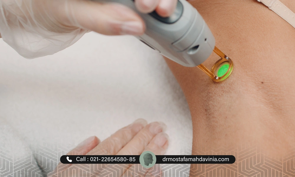 لیزر موهای زائد زیر بغل با دستگاه کندلا