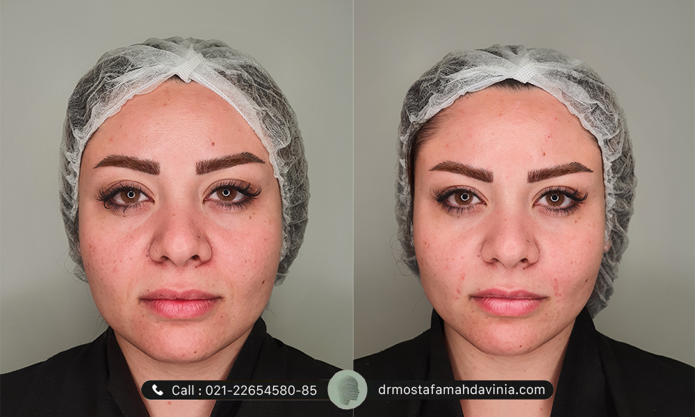 تزریق ژل صورت قبل و بعد